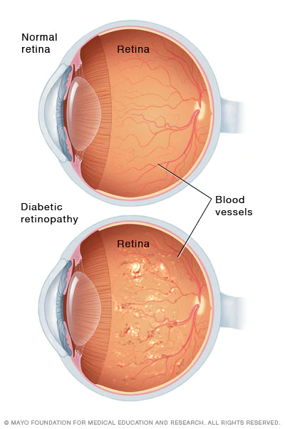 Diabetic Retinopathy Eye Anatomy