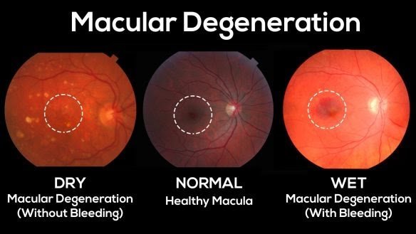 Wet and Dry Macular Degeneration