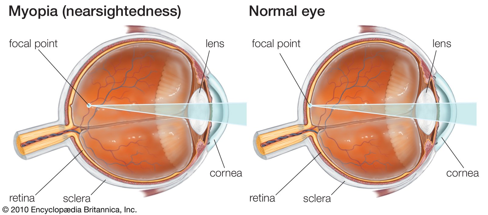 Nearsightedness, Myopia
